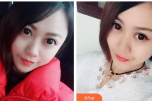 內(nèi)蒙古盛禧醫(yī)療美容門診部史栗豐整形價(jià)格表附激光點(diǎn)痣案例展示