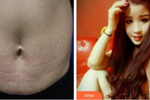 內(nèi)蒙古盛禧醫(yī)療美容門診部程芳芳整形價(jià)格表附祛妊娠紋案例展示