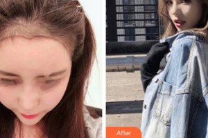 南昌宏昌醫(yī)院毛發(fā)種植中心江文俊整形價(jià)格表附植發(fā)案例展示