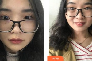 呼和浩特閆小林醫(yī)療美容門診部張克生整形價格表附光子嫩膚案例展示