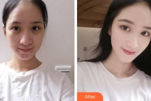 呼和浩特伊思整形?？漆t(yī)院白莉整形價格表附紅藍(lán)光祛痘案例展示