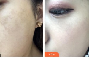 呼和浩特五洲女子醫(yī)院整形美容中心李峰整形價格表附激光祛斑案例展示