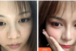 呼和浩特任榮大韓醫(yī)療美容診所崔鐘武整形價格表附激光祛斑案例展示