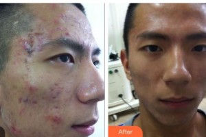 呼和浩特任榮大韓醫(yī)療美容診所李靜整形價格表附紅藍(lán)光祛痘案例展示