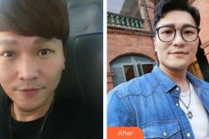 呼和浩特任榮大韓醫(yī)療美容診所趙一波整形價格表附光子嫩膚案例展示