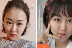 呼和浩特市第一醫(yī)院醫(yī)療整形美容中心武劍茹整形價格表附紅藍(lán)光祛痘案例展示