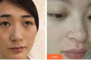 呼和浩特王冀賢醫(yī)療美容診所王冀賢整形價格表附清潔祛痘案例展示