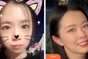 呼和浩特董志新口腔門診部金霞整形價格表附金屬托槽矯正案例展示