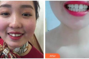 呼和浩特董志新口腔門診部董秀蘭整形價格表附牙齒隱形矯正案例展示