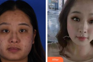 呼和浩特朝聚眼科醫(yī)院張貴森整形價格表附眼部綜合案例展示