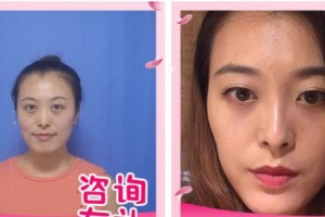 呼和浩特朝聚眼科醫(yī)院韓晶巖整形價格表附激光去眼袋案例展示