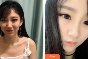 包頭華美醫(yī)療美容醫(yī)院潘在常整形價格表附鼻部綜合案例展示