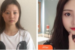 包頭李德皮膚醫(yī)院常建民整形價格表附硅膠隆鼻例展示