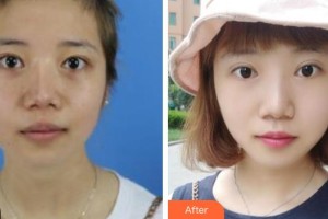 包頭李德皮膚醫(yī)院楊高云整形價格表附激光祛斑案例展示