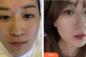 包頭劉恕醫(yī)療美容診所劉怒整形價格表附激光祛斑案例展示