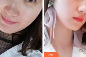 包頭華美醫(yī)療美容醫(yī)院白虎整形價格表附激光祛斑案例展示