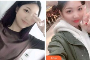 包頭貝特瑞爾口腔門診部王鳳英整形價格表附根管調(diào)節(jié)案例展示