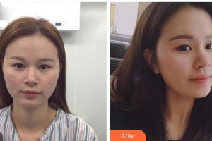 包頭朝聚眼科醫(yī)院孔新萍整形價格表附切開雙眼皮案例展示