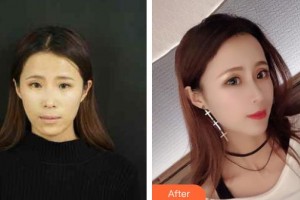 烏海市人民醫(yī)院整形外科馬語遙整形價格表附耳軟骨復(fù)合隆鼻案例展示