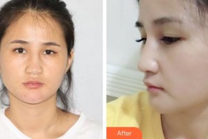 烏海市人民醫(yī)院整形外科趙軍委整形價格表附鼻部綜合案例展示