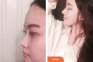 赤峰現(xiàn)代婦產(chǎn)醫(yī)院醫(yī)療美容科趙宏偉整形價格表附鼻部綜合例展示