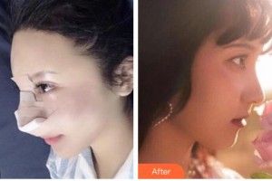 赤峰現(xiàn)代婦產(chǎn)醫(yī)院醫(yī)療美容科張守玲整形價格表附鼻部綜合案例展示