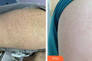 赤峰現(xiàn)代婦產(chǎn)醫(yī)院醫(yī)療美容科肖璇整形價格表附清潔祛痘案例展示