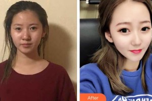 赤峰麗都整形美容醫(yī)院聶影整形價格表附鼻部綜合案例展示