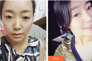 赤峰麗都整形美容醫(yī)院潘福強(qiáng)整形價格表附鼻部綜合案例展示