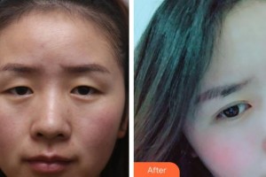 赤峰朝聚眼科醫(yī)院齊穎整形價格表附激光去眼袋案例展示