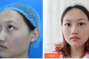 赤峰朝聚眼科醫(yī)院侯桂梅整形價格表附激光去眼袋案例展示