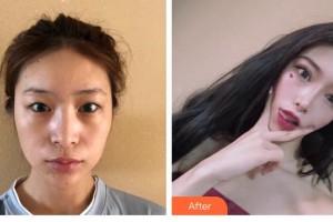 赤峰張安鳳醫(yī)療美容醫(yī)院張安鳳整形價格表附眼部綜合案例展示