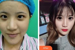 赤峰淑香醫(yī)療整形美容醫(yī)院喬淑香整形價格表附切開雙眼皮案例展示