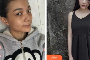 通遼京韓創(chuàng)美醫(yī)療美容診所于海波整形價格表附開內(nèi)眼角案例展示