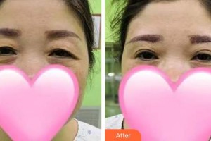 通遼張大夫醫(yī)療美容診所張杰整形價格表附切眉術(shù)案例展示