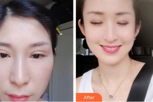 通遼馬皓醫(yī)療美容醫(yī)院馬皓整形價格表附切開雙眼皮案例展示