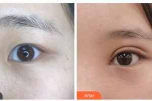 通遼京韓創(chuàng)美醫(yī)療美容診所葉珊整形價格表附眼部綜合案例展示