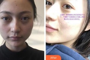 鄂爾多斯百達(dá)麗整形美容醫(yī)院張琳琳整形價格表附激光點痣案例展示