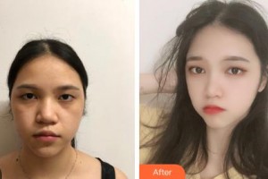 鄂爾多斯天王醫(yī)學(xué)美容醫(yī)院吳麗英整形價格表附去痘印痘坑案例展示