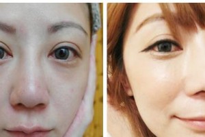 鄂爾多斯天王醫(yī)學(xué)美容醫(yī)院王殿博整形價格表附光子嫩膚案例展示