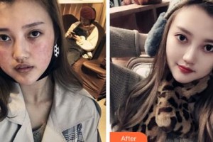 鄂爾多斯市中心醫(yī)院燒傷整形科張玉萍整形價格表附清潔祛痘案例展示