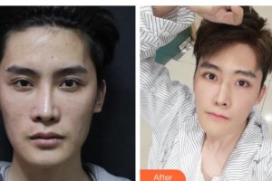 鄂爾多斯武瑞明醫(yī)學(xué)美容整形醫(yī)院張瑞鳳整形價格表附激光祛斑案例展示