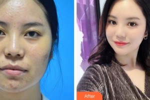 鄂爾多斯天王醫(yī)學(xué)美容醫(yī)院王淑珍整形價(jià)格表附去痘印痘坑案例展示