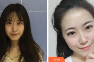 鄂爾多斯天王醫(yī)學(xué)美容醫(yī)院梁曉健整形價(jià)格表附無(wú)針?biāo)獍咐故?>
</a>
<h3 class=