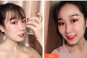 鄂爾多斯口腔醫(yī)院王曉霞整形價(jià)格表附牙齒隱形矯正案例展示