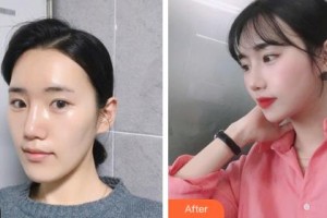 烏蘭察布美尚美醫(yī)學(xué)美容整形醫(yī)院樸圣勛整形價(jià)格表附眼部綜合案例展示