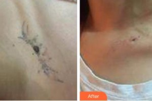 吉林銘醫(yī)整形美容醫(yī)院白英浩整形價(jià)格表附激光去紋身案例展示