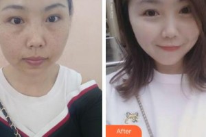 吉林銘醫(yī)整形美容醫(yī)院王丹丹整形價(jià)格表附激光祛斑案例展示