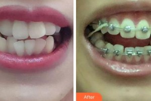 吉林大學(xué)口腔醫(yī)院口腔頜面外科徐洋整形價(jià)格表附金屬托槽矯正案例展示