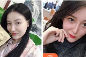 吉林吉化集團(tuán)總醫(yī)院燒傷整形科田寶祥整形價(jià)格表附清潔祛痘案例展示